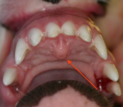 incisive papilla,mouth,dentistry,Jacobson's Organ